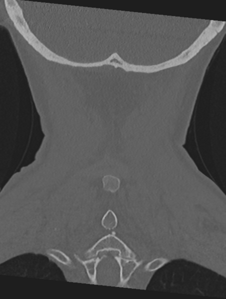 File:Cervical spondylolysis (Radiopaedia 49616-54811 Coronal bone window 51).png