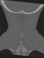 Cervical spondylolysis (Radiopaedia 49616-54811 Coronal bone window 51).png