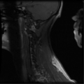 Cervical vertebrae metastasis (Radiopaedia 78814-91667 G 3).png