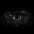 Cesarian section scar endometriosis (Radiopaedia 66520-75799 Axial DWI 6).jpg