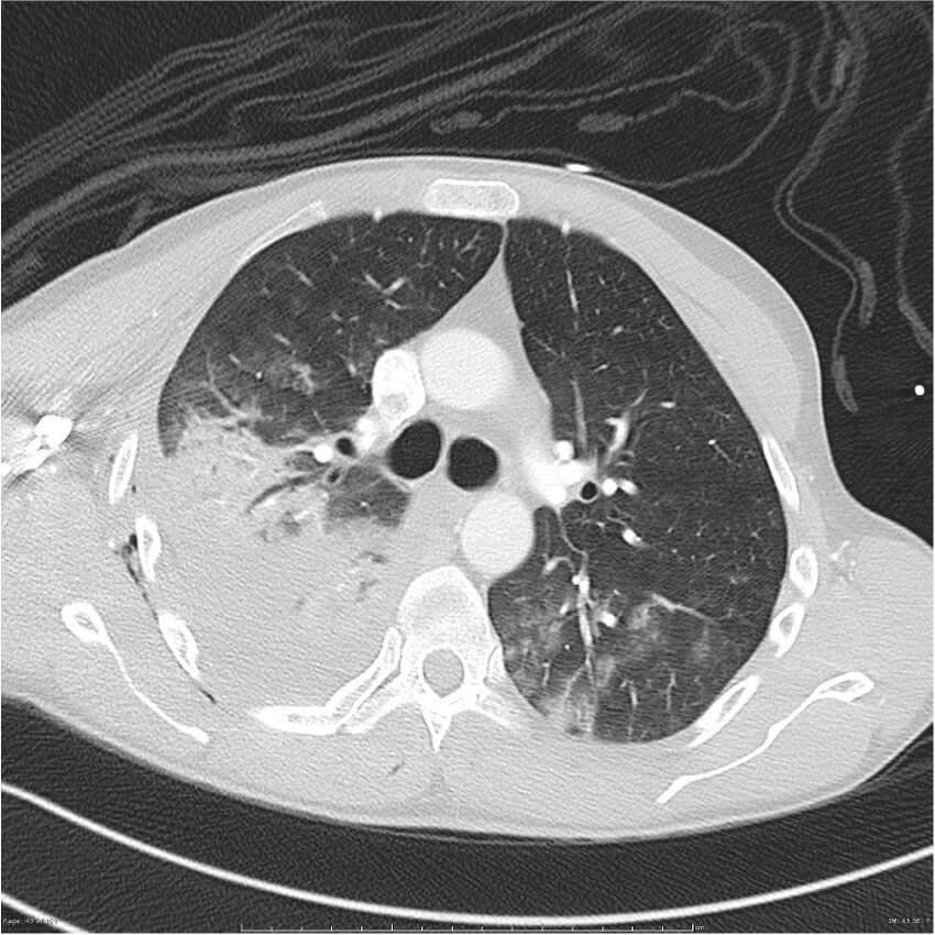 Chest and abdomen multi-trauma (Radiopaedia 26294-26425 lung window 43).jpg