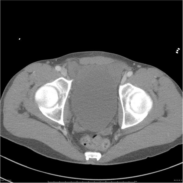 File:Chest and abdomen multi-trauma (Radiopaedia 26294-26426 bone window 81).jpg