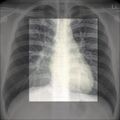 Chest x-ray - circulation (Radiopaedia 32664-33633 F 1).jpg
