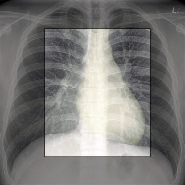 File:Chest x-ray - circulation (Radiopaedia 32664-33633 F 1).jpg