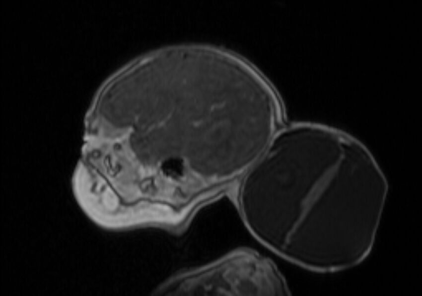 Chiari III malformation with occipital encephalocele (Radiopaedia 79446-92559 Sagittal T1 C+ mpr 20).jpg