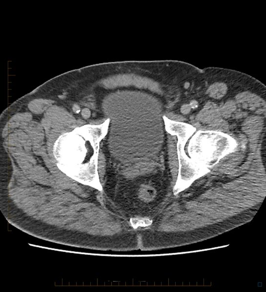 File:Chicken bone in anal canal (Radiopaedia 51490-57253 Axial non-contrast 5).jpg