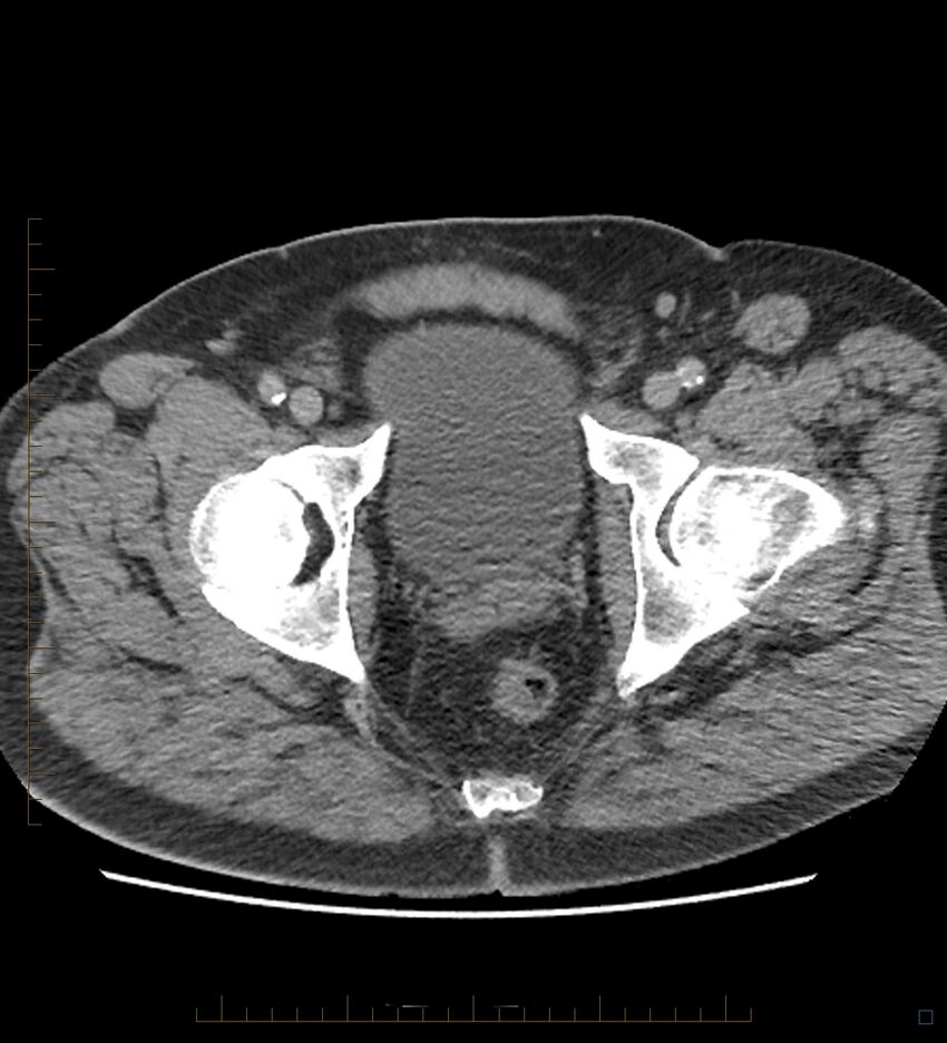 Chicken bone in anal canal (Radiopaedia 51490-57253 Axial non-contrast 5).jpg