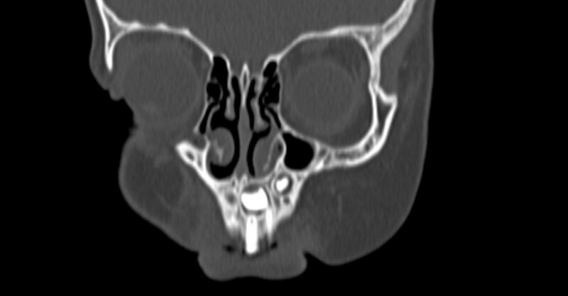File:Choanal atresia (Radiopaedia 51295-56972 Coronal bone window 6).jpg