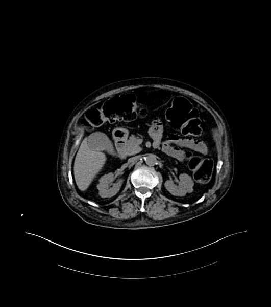 File:Cholangiocarcinoma with cerebral metastases (Radiopaedia 83519-98629 Axial non-contrast 38).jpg