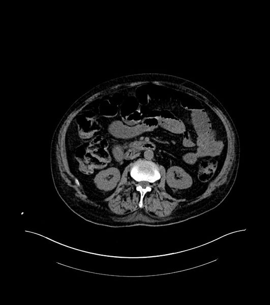 File:Cholangiocarcinoma with cerebral metastases (Radiopaedia 83519-98629 Axial non-contrast 50).jpg