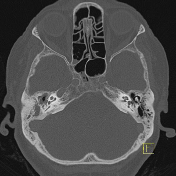 File:Cholesteatomatous chronic otitis (Radiopaedia 14993-14911 Axial bone window 12).JPEG
