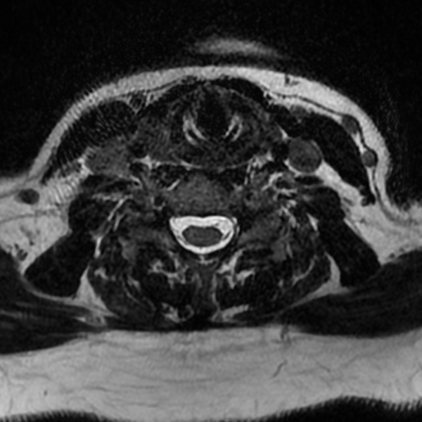 File:Chordoma - cervical spine (Radiopaedia 70084-80111 Axial T2 62).png