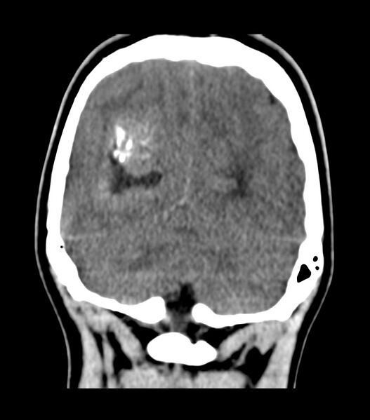 File:Choroid plexus carcinoma (Radiopaedia 91013-108552 Coronal non-contrast 69).jpg