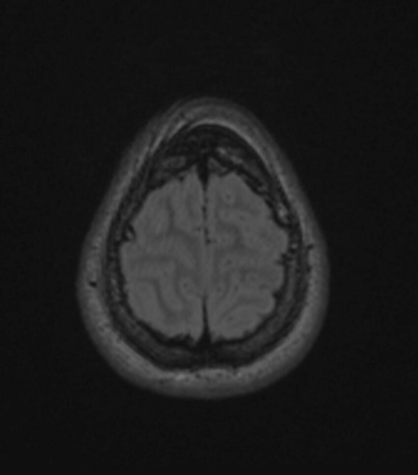 Choroid plexus carcinoma (Radiopaedia 91013-108553 Axial FLAIR C+ 190).jpg