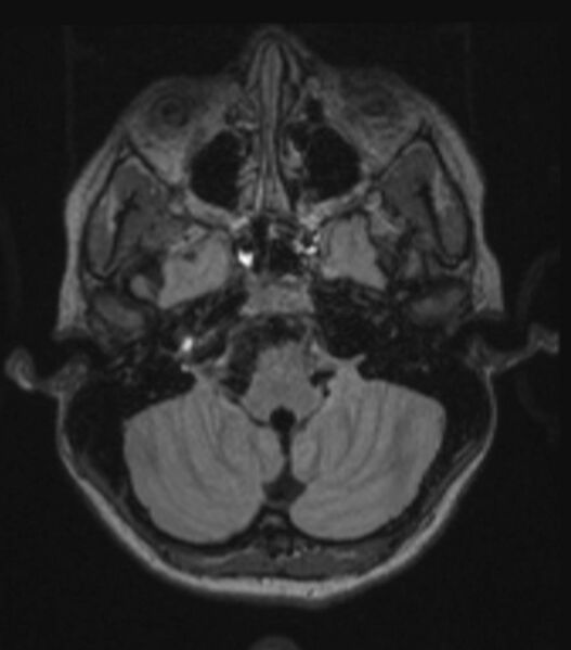File:Choroid plexus carcinoma (Radiopaedia 91013-108553 Axial FLAIR C+ 88).jpg