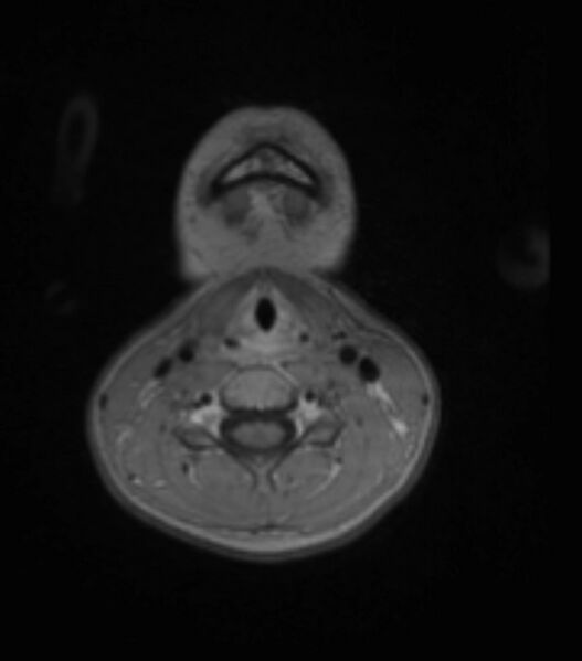 File:Choroid plexus carcinoma (Radiopaedia 91013-108553 Axial T1 C+ 9).jpg