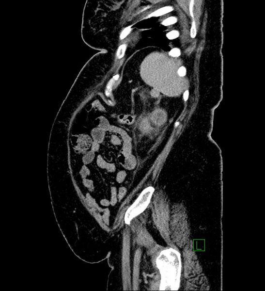 File:Chromophobe renal cell carcinoma (Radiopaedia 84239-99519 G 23).jpg