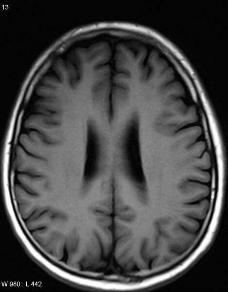 File:Chronic lymphocytic inflammation with pontine perivascular enhancement responsive to steroids (CLIPPERS) (Radiopaedia 37520-39374 Axial T1 12).jpg