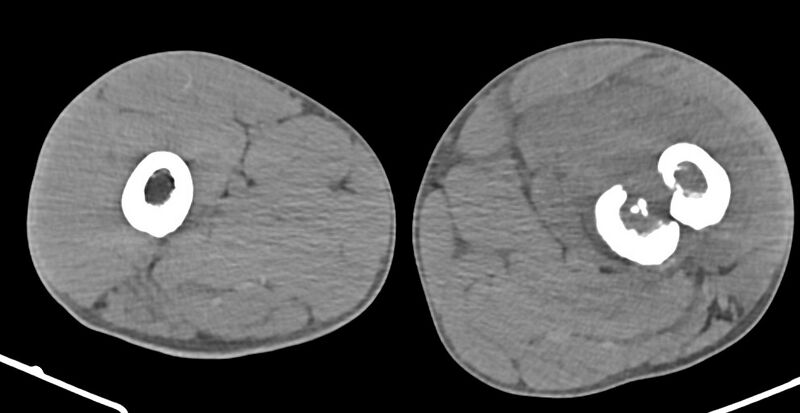 File:Chronic osteomyelitis (with sequestrum) (Radiopaedia 74813-85822 Axial 260).jpg