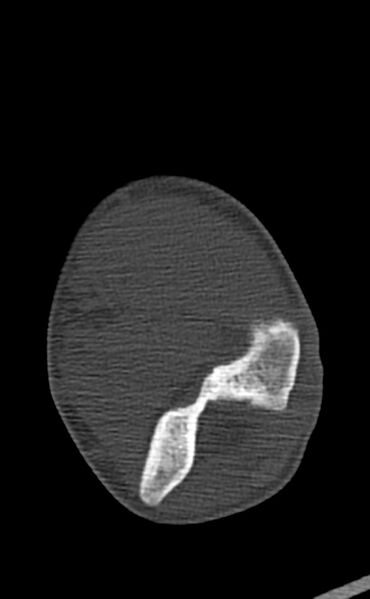 File:Chronic osteomyelitis of the distal humerus (Radiopaedia 78351-90971 Axial bone window 85).jpg