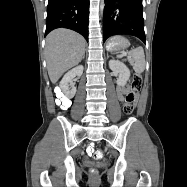 File:Chronic pancreatitis (Radiopaedia 21022-20949 C 13).jpg