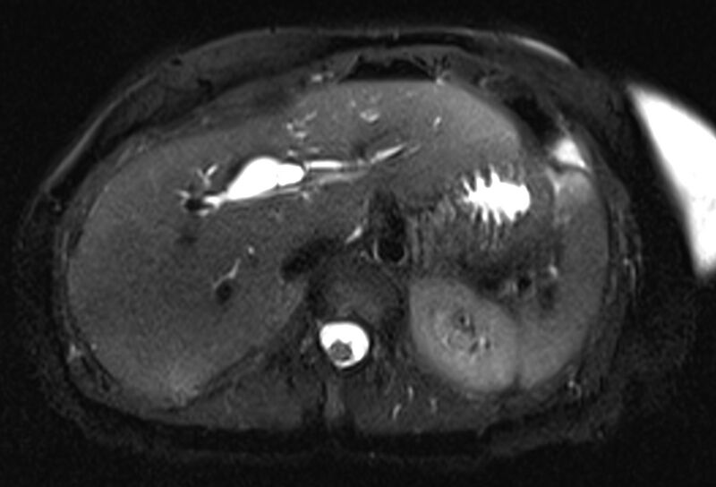 File:Chronic pancreatitis - pancreatic duct calculi (Radiopaedia 71818-82250 Axial T2 fat sat 17).jpg