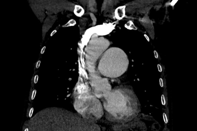 File:Chronic pulmonary embolism with bubbly consolidation (Radiopaedia 91248-108850 B 56).jpg