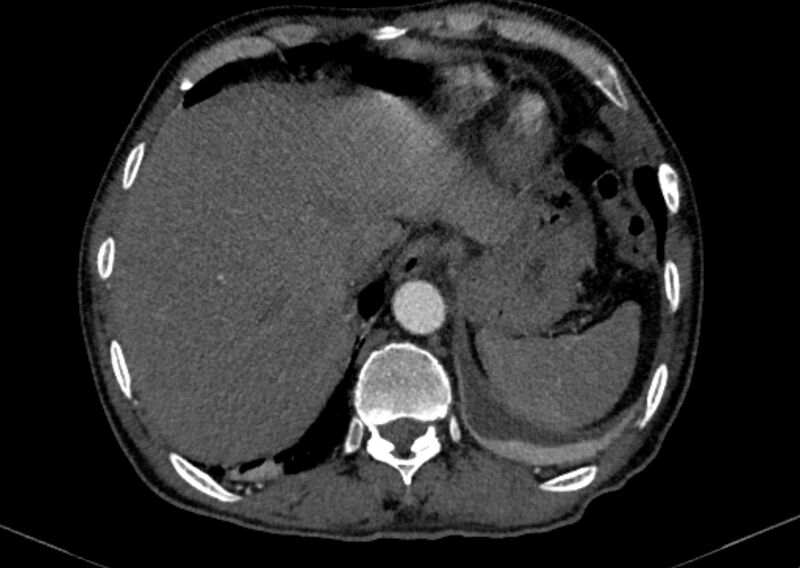 File:Chronic pulmonary embolism with bubbly consolidation (Radiopaedia 91248-108850 C+ arterial phase 130).jpg