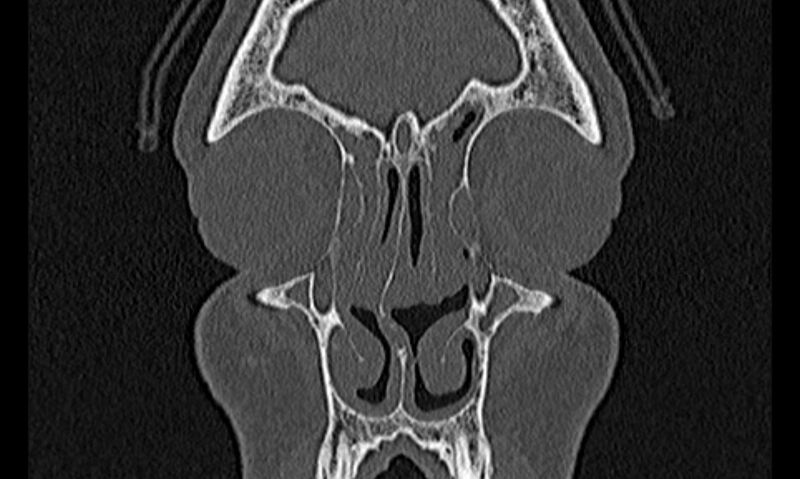 File:Chronic rhinosinusitis (Radiopaedia 65079-74075 Coronal bone window 16).jpg