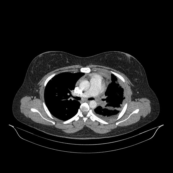 File:Chronic thromboembolic pulmonary hypertension (CTEPH) (Radiopaedia 74597-85532 Axial C+ CTPA 99).jpg