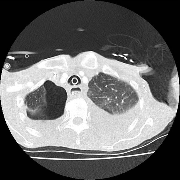 File:Clagett thoracotomy with bronchopleural fistula (Radiopaedia 29192-29587 Axial lung window 8).jpg