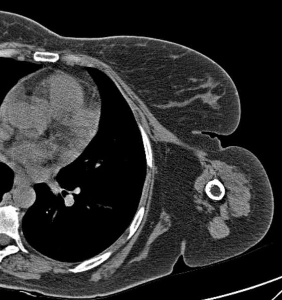 File:Clear cell chondrosarcoma - humerus (Radiopaedia 63104-71612 Axial non-contrast 92).jpg