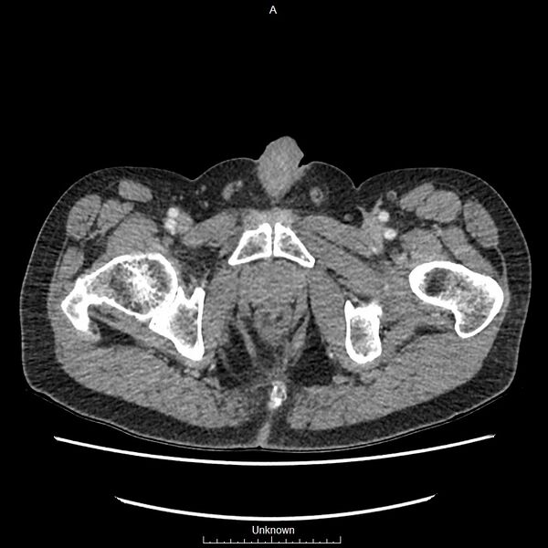 File:Closed loop bowel obstruction and ischemia (Radiopaedia 86959-103180 A 91).jpg
