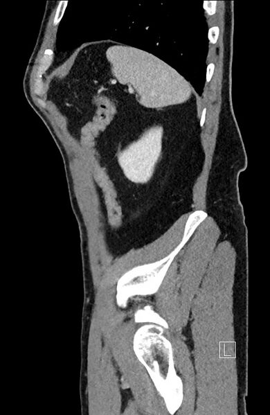 File:Closed loop small bowel obstruction - internal hernia (Radiopaedia 57806-64778 C 23).jpg