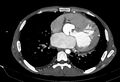 Coarctation of aorta with aortic valve stenosis (Radiopaedia 70463-80574 A 126).jpg