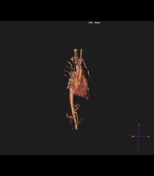 File:Coarctation of the aorta (Radiopaedia 43373-46729 3D reconstruction 30).jpg