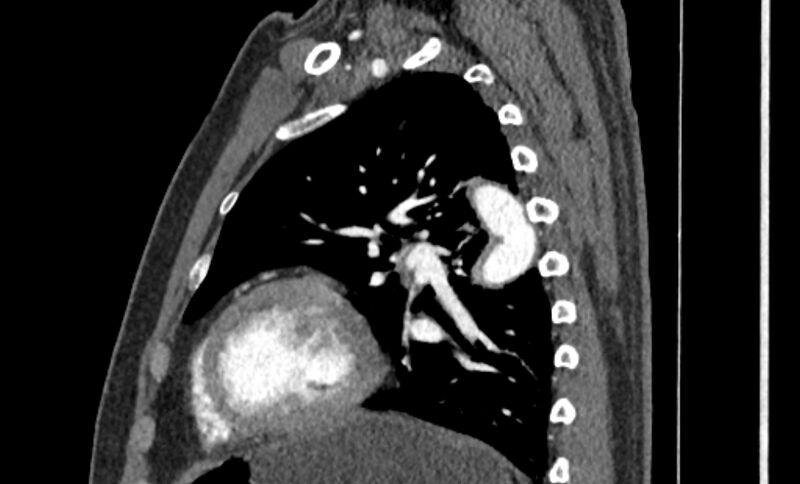 File:Coarctation of the aorta (Radiopaedia 53363-59343 B 48).jpg