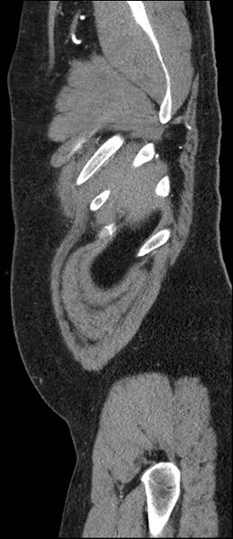 File:Coarctation of the aorta (Radiopaedia 74632-88521 C 15).jpg