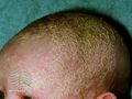Cradle cap (DermNet NZ dermatitis-cradlecap5).jpg