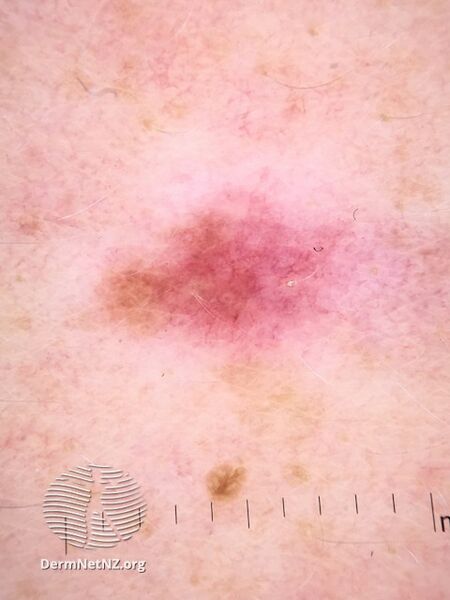 File:Dermoscopic image of amelanotic melanoma 2 (DermNet NZ amelanotic-melanoma1-dermoscopy).jpg