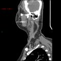 Nasopharyngeal lymphoma (Radiopaedia 54235-60433 B 48).jpg