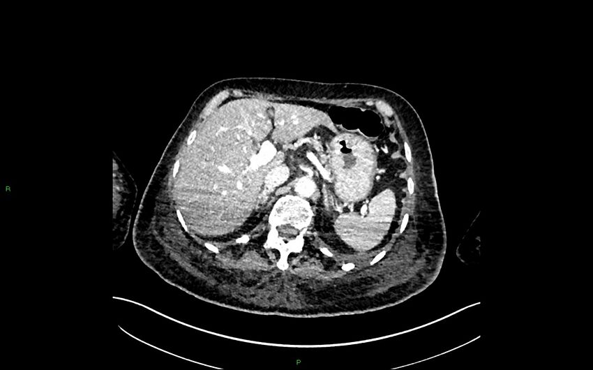 Neo-terminal ileal stricture (Crohn disease) (Radiopaedia 33790-34948 A 102).jpg