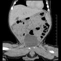 Neonatal neuroblastoma (Radiopaedia 56651-63438 Coronal non-contrast 20).jpg