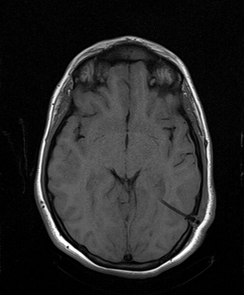 File:Neurofibromatosis type 2 (Radiopaedia 66211-75401 Axial T1 15).jpg