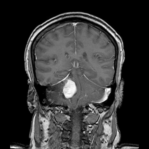 File:Neurofibromatosis type 2 (Radiopaedia 67470-76871 Coronal T1 C+ 16).jpg