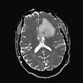 Neurotoxoplasmosis - concentric target sign (Radiopaedia 70644-80784 Axial ADC 13).jpg