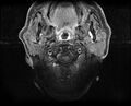Non-Hodgkin lymphoma - parotid gland (Radiopaedia 71531-81890 Axial T1 C+ fat sat 15).jpg