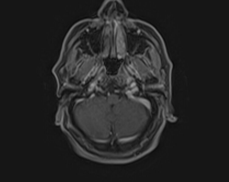 File:Non-Hodgkin lymphoma - parotid gland (Radiopaedia 71531-81890 E 18).jpg