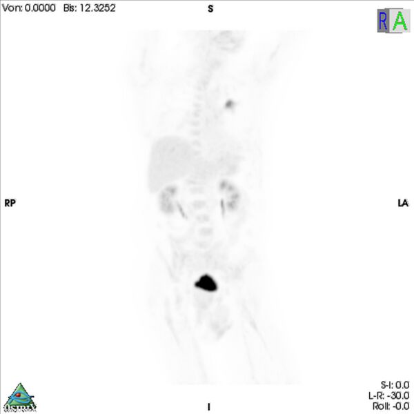File:Non-Hodgkin lymphoma involving seminal vesicles with development of interstitial pneumonitis during Rituximab therapy (Radiopaedia 32703-33752 PET cor 3D MIP 12).jpg
