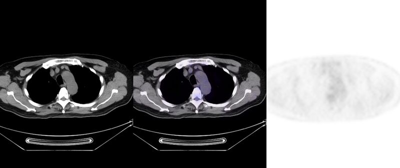 File:Non-Hodgkin lymphoma involving seminal vesicles with development of interstitial pneumonitis during Rituximab therapy (Radiopaedia 32703-33752 ax CT Fus PET 16).jpg